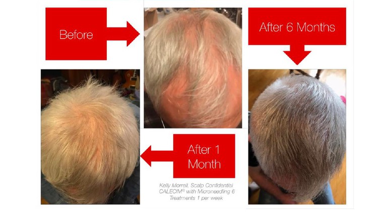 Microneedling for hairloss with Stem Cells